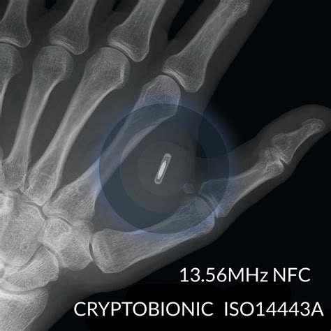 nfc tag implant but|first rfid implant.